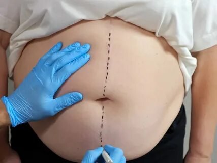 BodyTite Liposuction Aftercare: Steps to Ensure Optimal Results